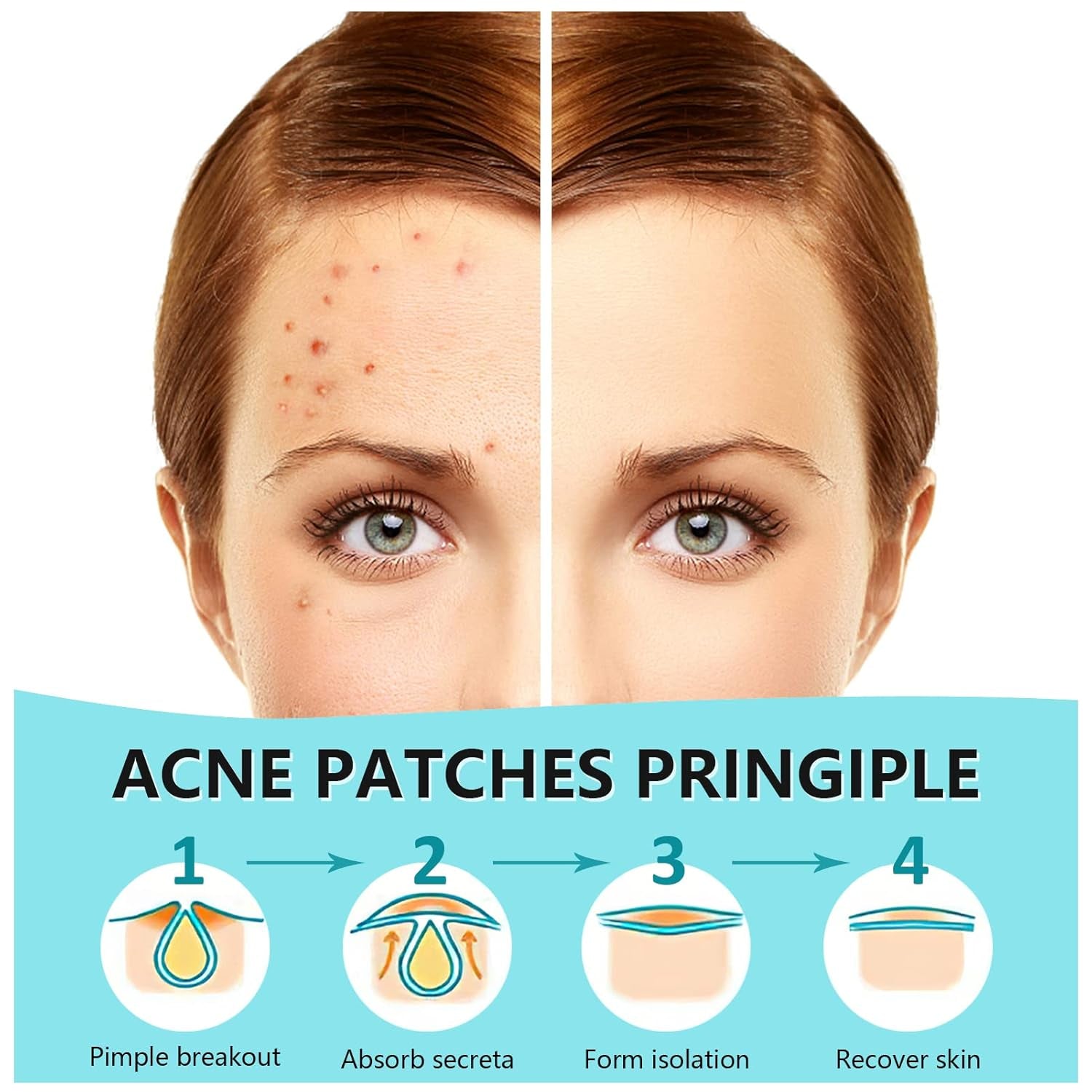 180 Hydrocolloid Pimple Patches - Invisible Acne Spot Treatment for Clearer Skin