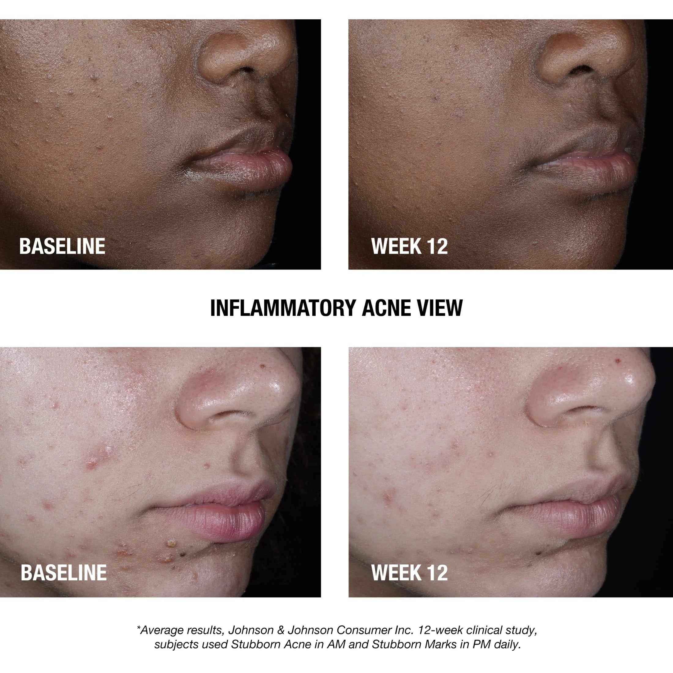 Powerful Stubborn Acne AM Treatment with 2.0% Benzoyl Peroxide - 2 Oz